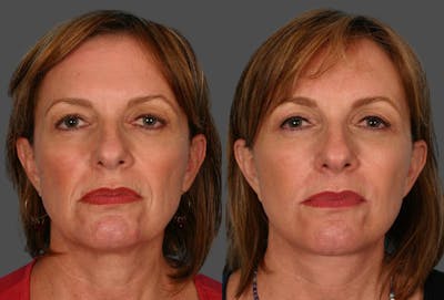 Restylane® Before & After Gallery - Patient 153372 - Image 1