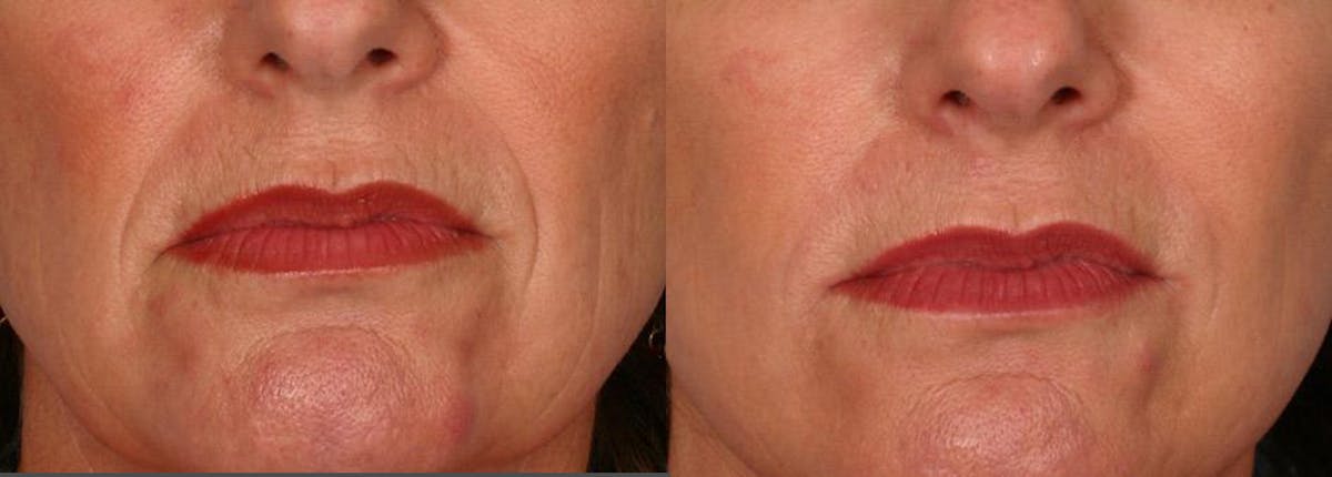 Restylane® Before & After Gallery - Patient 153372 - Image 2