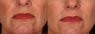 Restylane® Before & After Gallery - Patient 398275 - Image 1