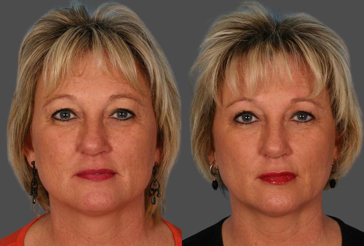 Restylane® Before & After Gallery - Patient 246440 - Image 1