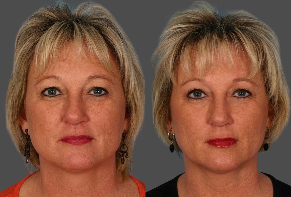 Restylane® Before & After Gallery - Patient 246440 - Image 1