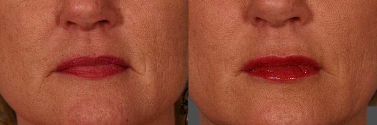 Lip Augmentation Before & After Gallery - Patient 312119 - Image 2