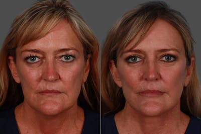 Lip Augmentation Before & After Gallery - Patient 220685 - Image 1