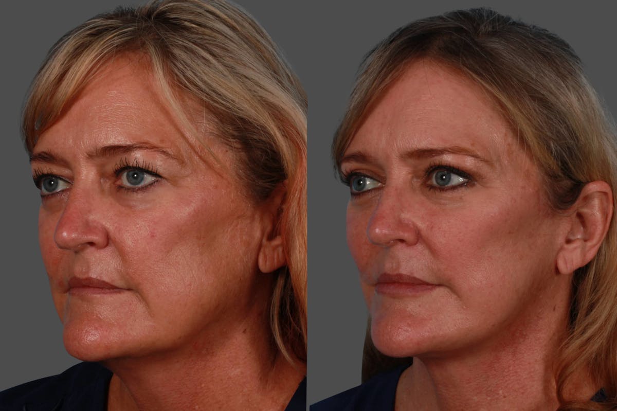 Lip Augmentation Before & After Gallery - Patient 220685 - Image 2