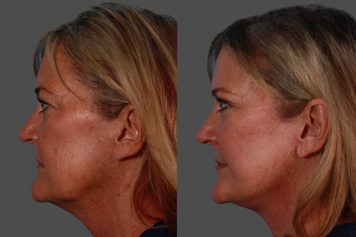 Lip Augmentation Before & After Gallery - Patient 220685 - Image 3
