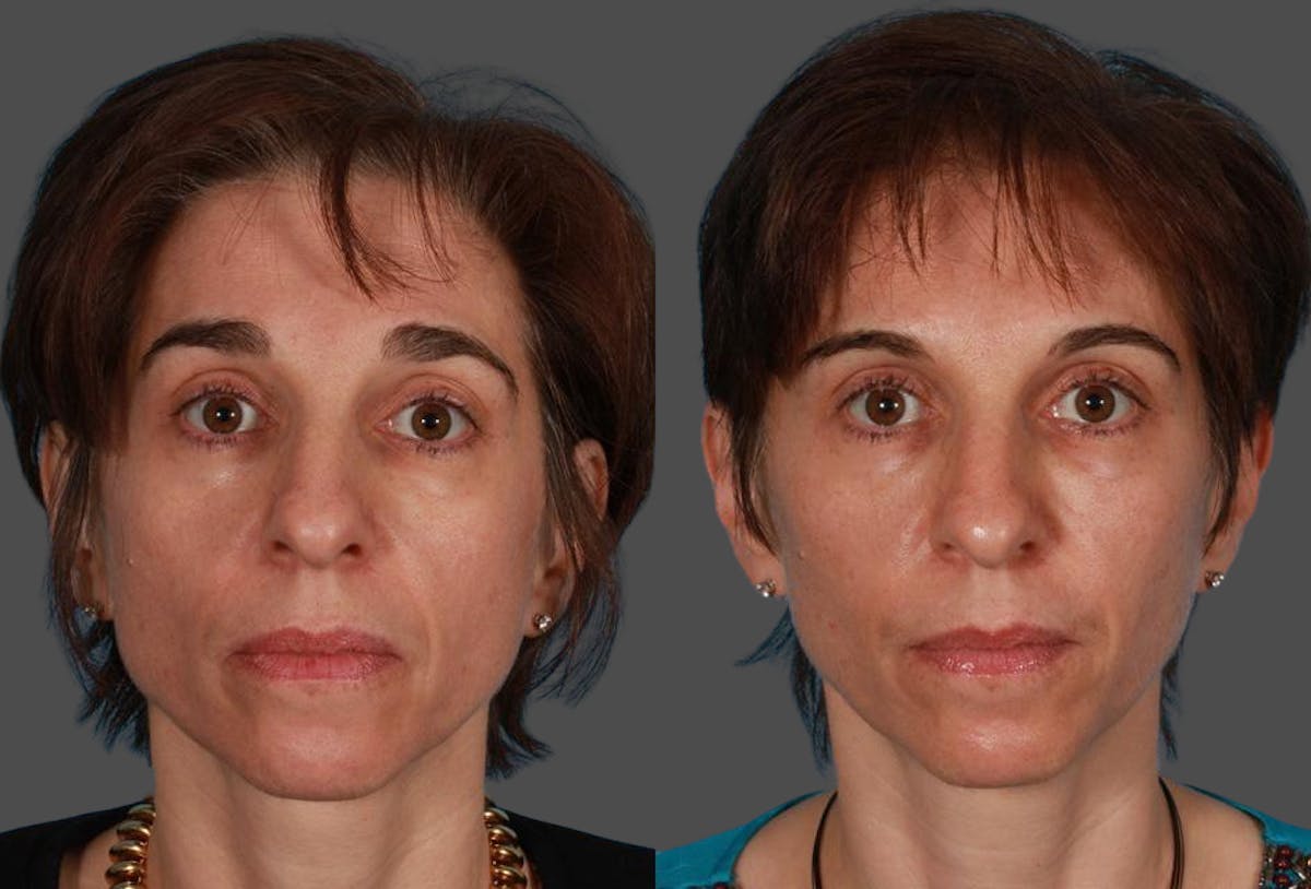 Sculptra Before & After Gallery - Patient 205144 - Image 1
