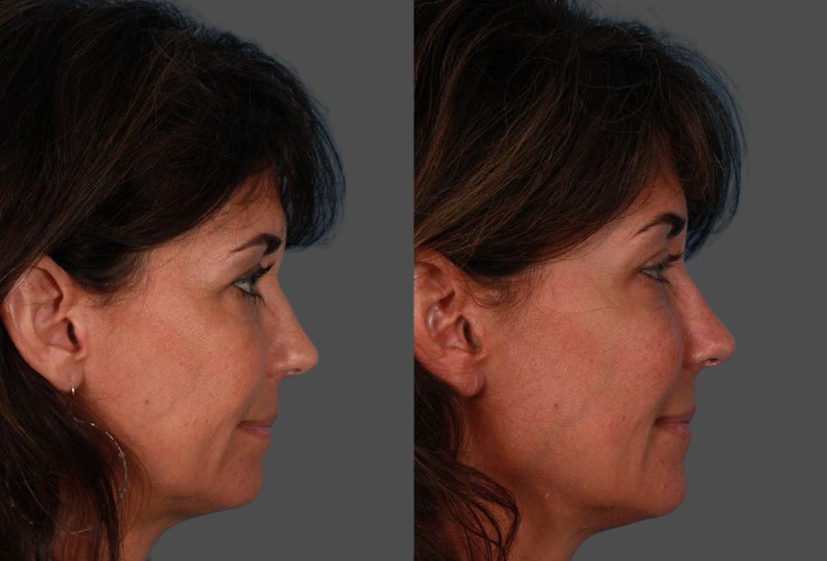 Sculptra Before & After Gallery - Patient 366467 - Image 3