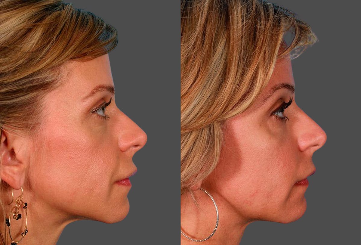 Sculptra Before & After Gallery - Patient 302081 - Image 3