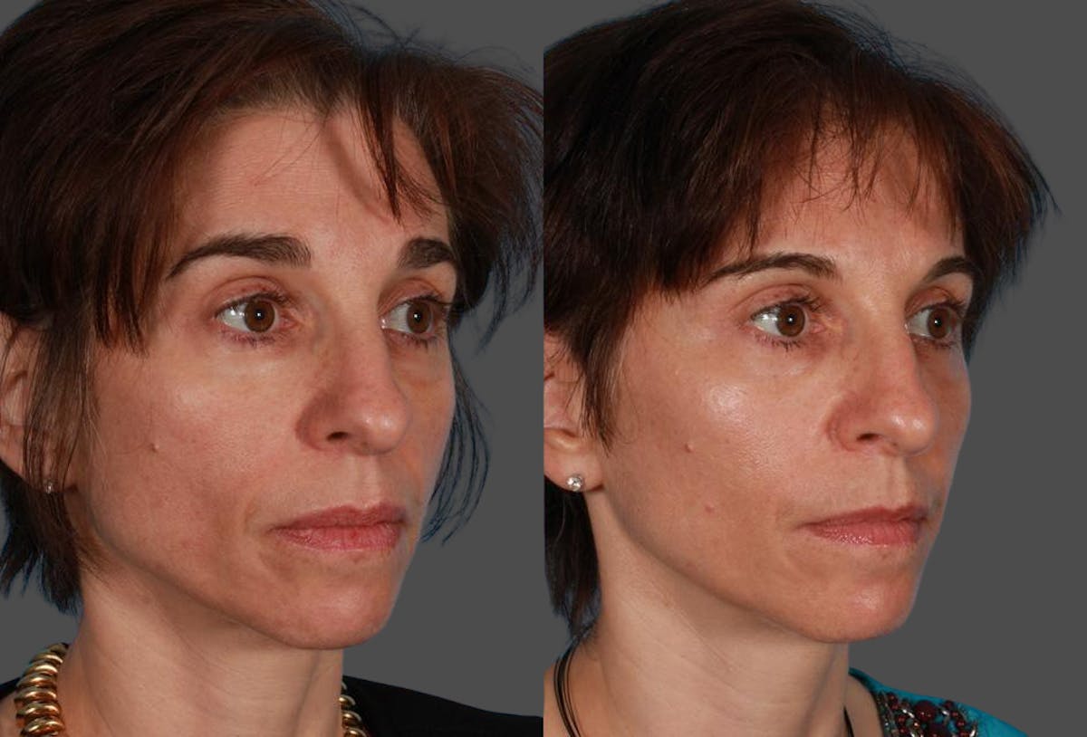 Sculptra Before & After Gallery - Patient 205144 - Image 2