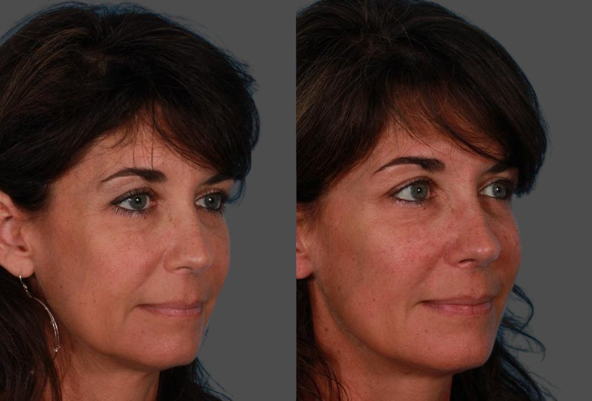 Sculptra Before & After Gallery - Patient 366467 - Image 2