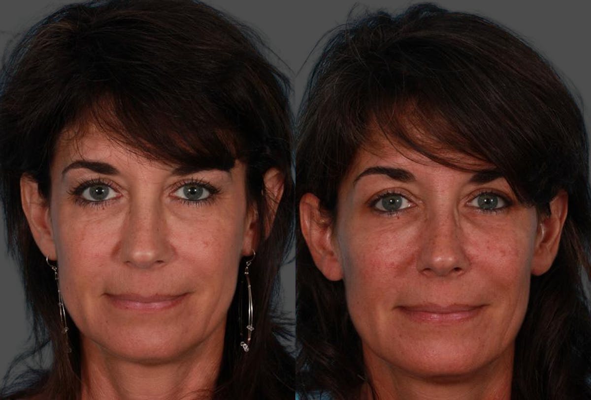 Sculptra Before & After Gallery - Patient 366467 - Image 1