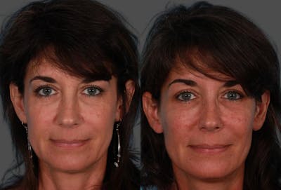 Sculptra Before & After Gallery - Patient 366467 - Image 1