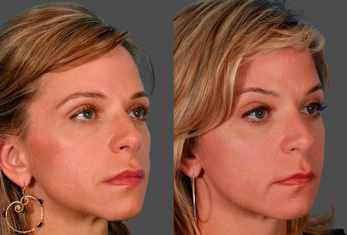 Sculptra Before & After Gallery - Patient 302081 - Image 2