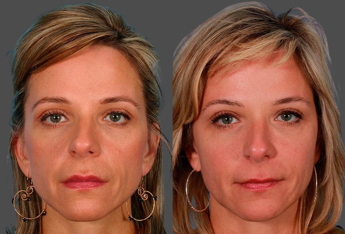 Sculptra Before & After Gallery - Patient 302081 - Image 1