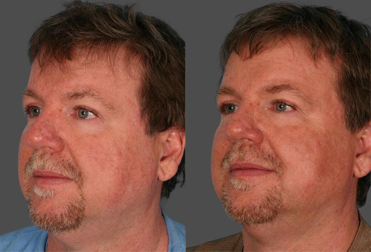 Rosacea Before & After Gallery - Patient 324414 - Image 1