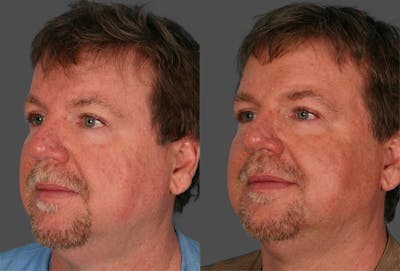 Rosacea Before & After Gallery - Patient 324414 - Image 1