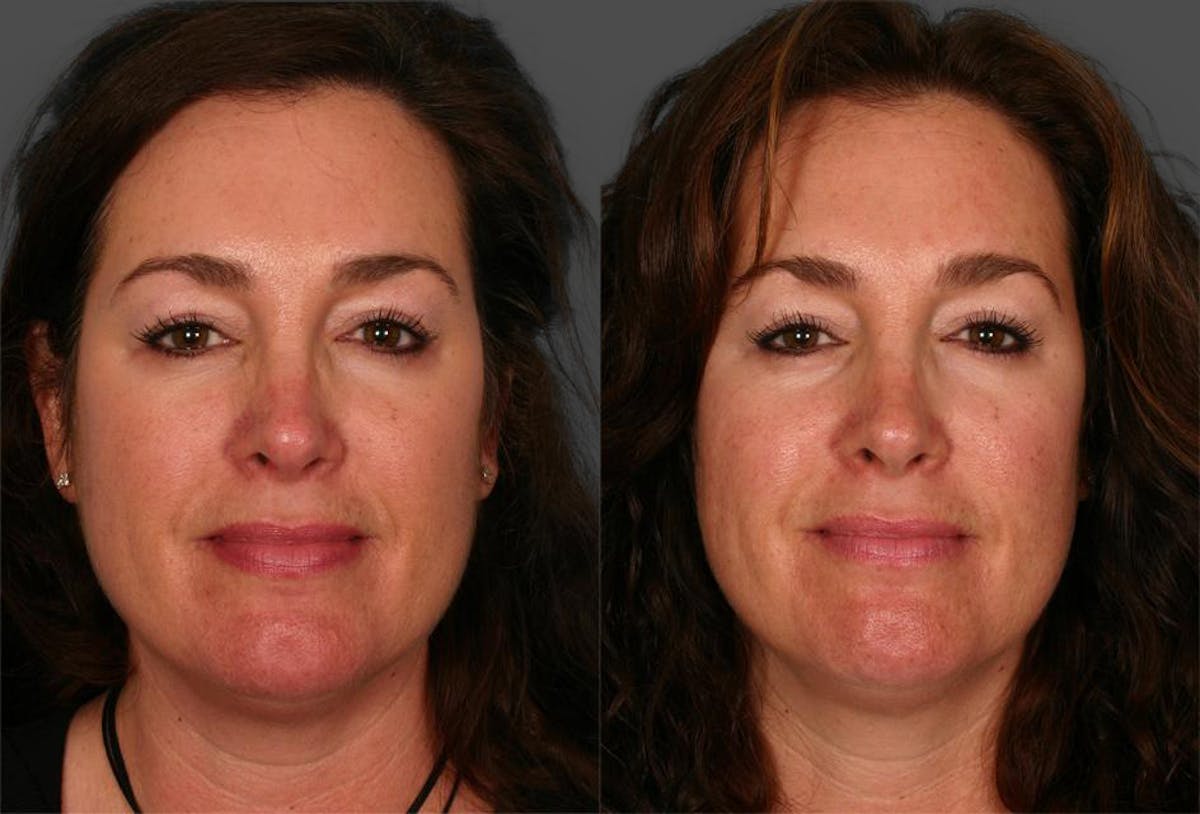 Rosacea Before & After Gallery - Patient 156214 - Image 1
