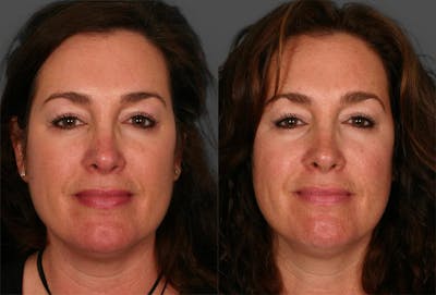 Rosacea Before & After Gallery - Patient 156214 - Image 1