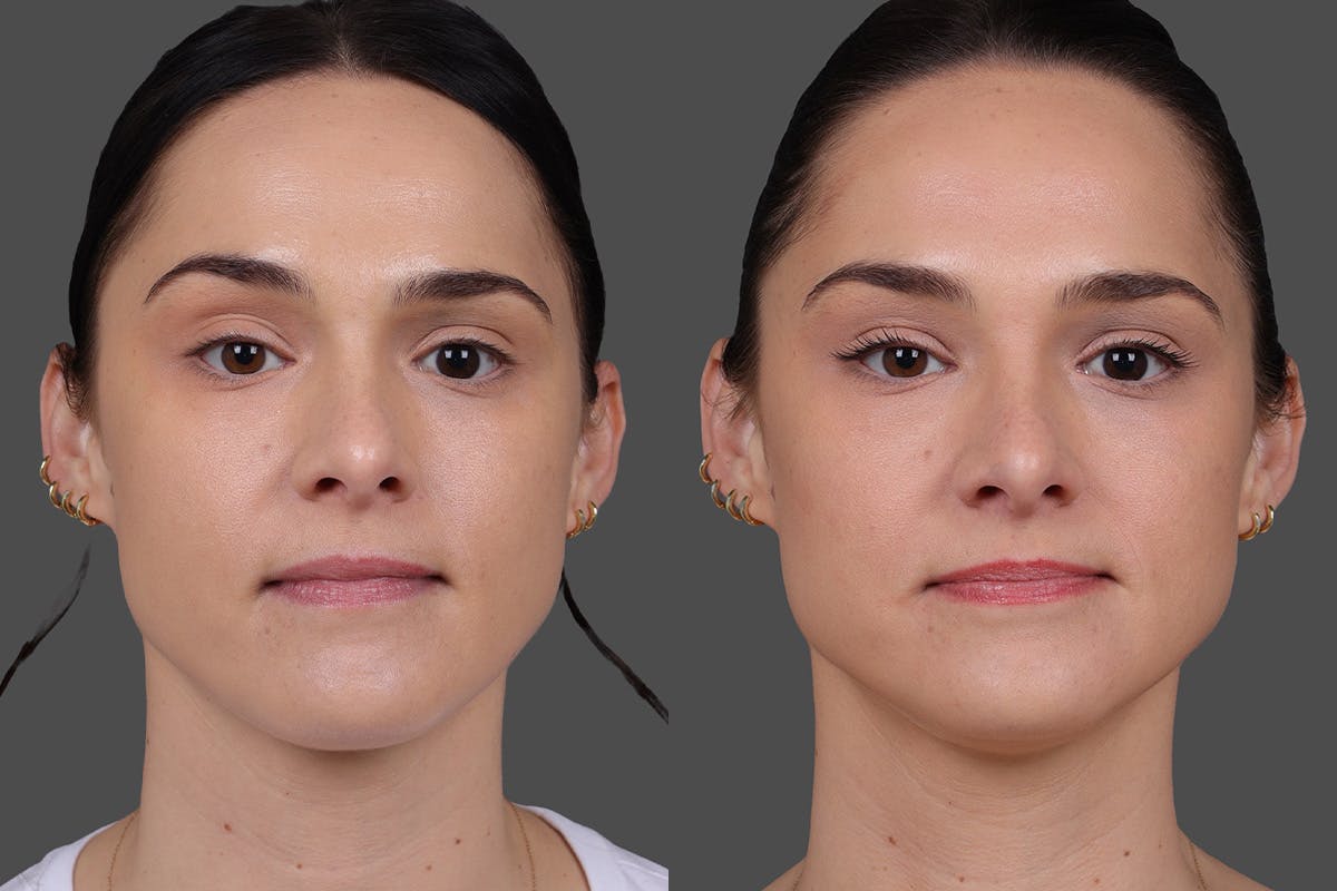 BOTOX® Before & After Gallery - Patient 931554 - Image 1