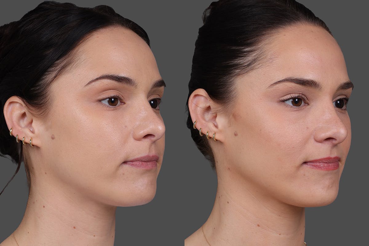 BOTOX® Before & After Gallery - Patient 931554 - Image 2