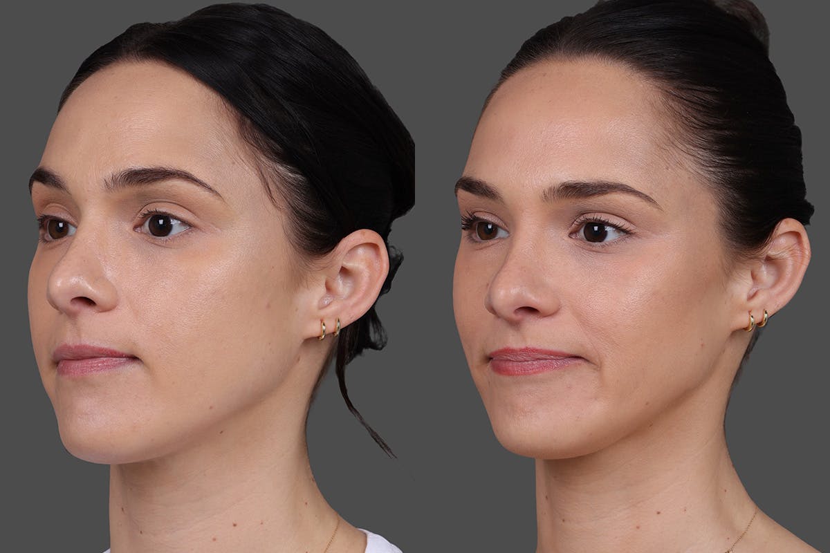 BOTOX® Before & After Gallery - Patient 931554 - Image 3