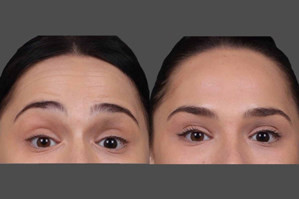 BOTOX® Before & After Gallery - Patient 931554 - Image 4