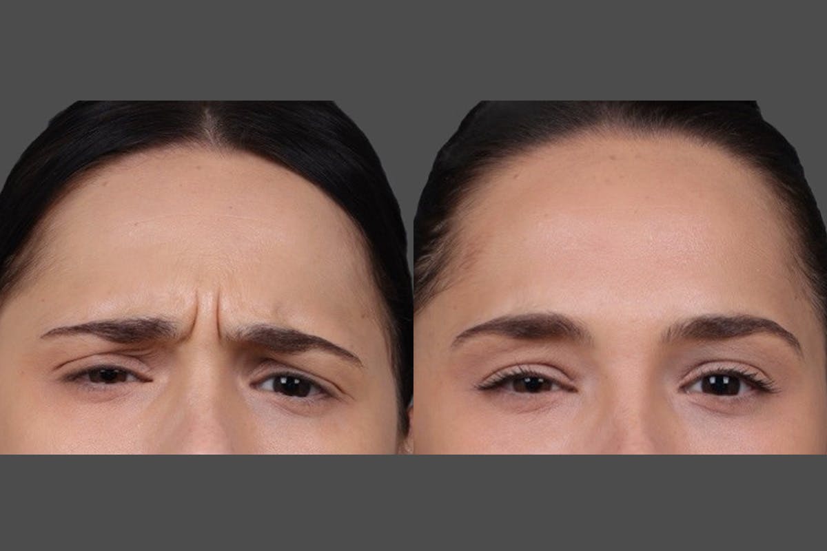 BOTOX® Before & After Gallery - Patient 931554 - Image 5