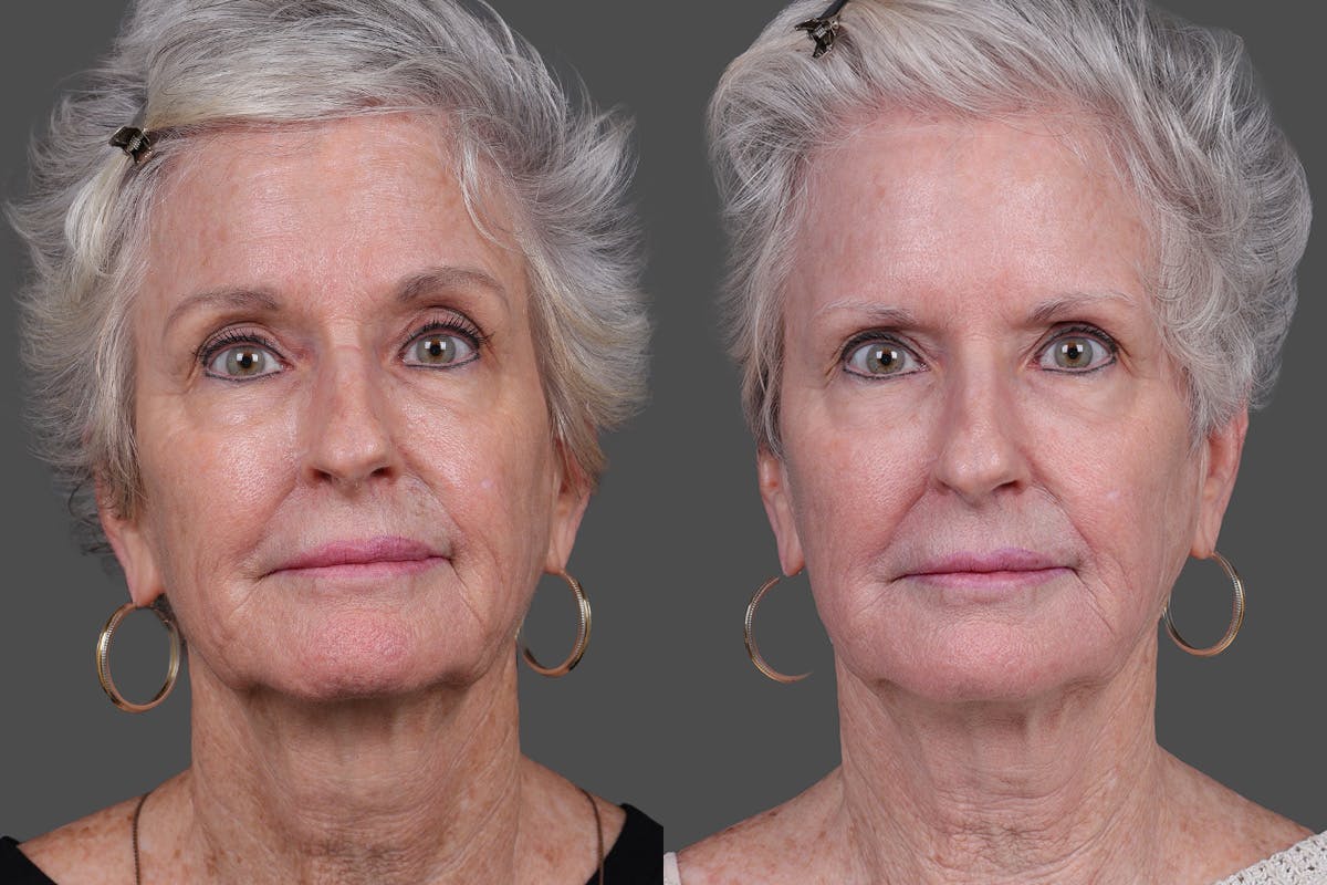 Lasers Before & After Gallery - Patient 100063 - Image 1
