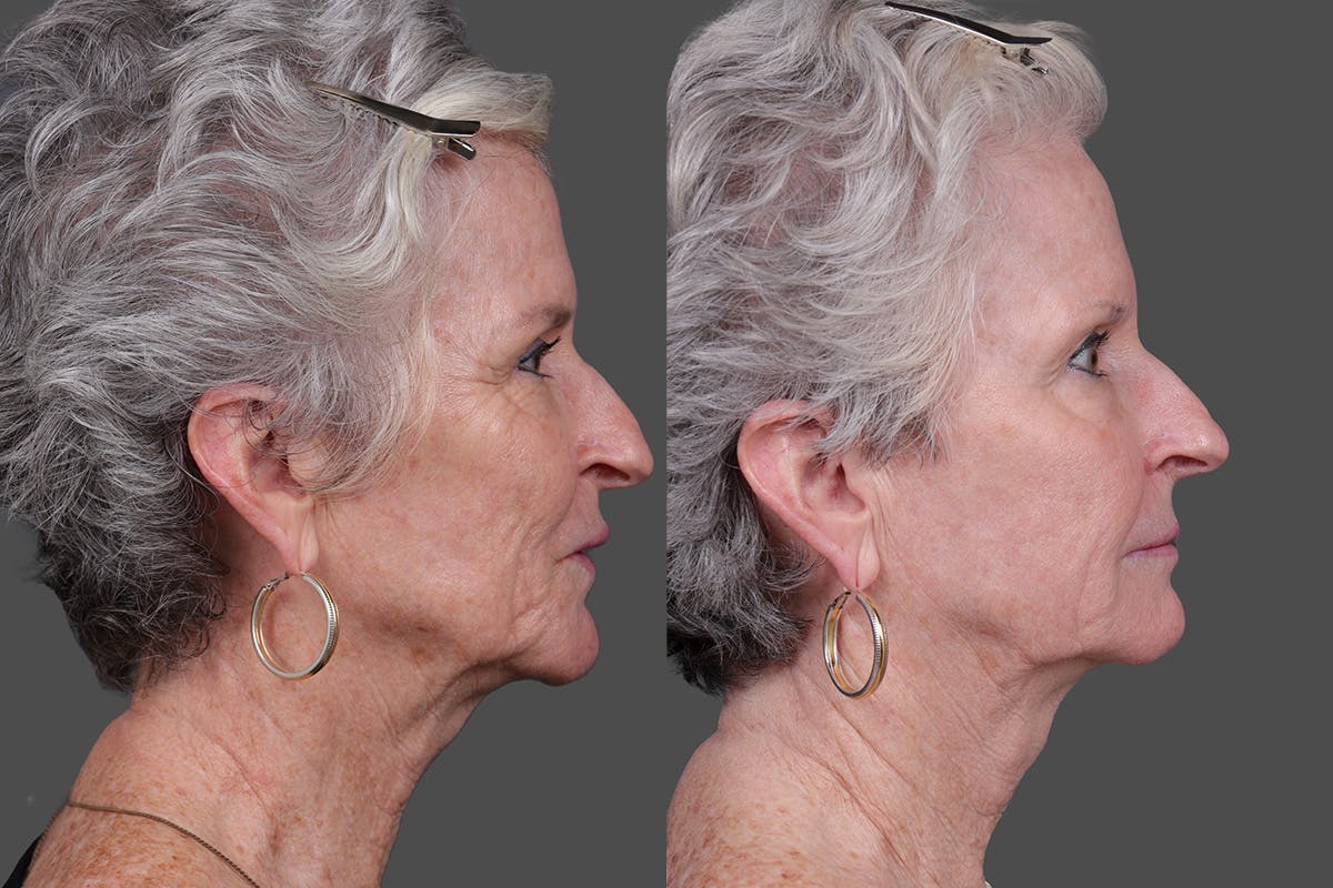 Lasers Before & After Gallery - Patient 100063 - Image 3