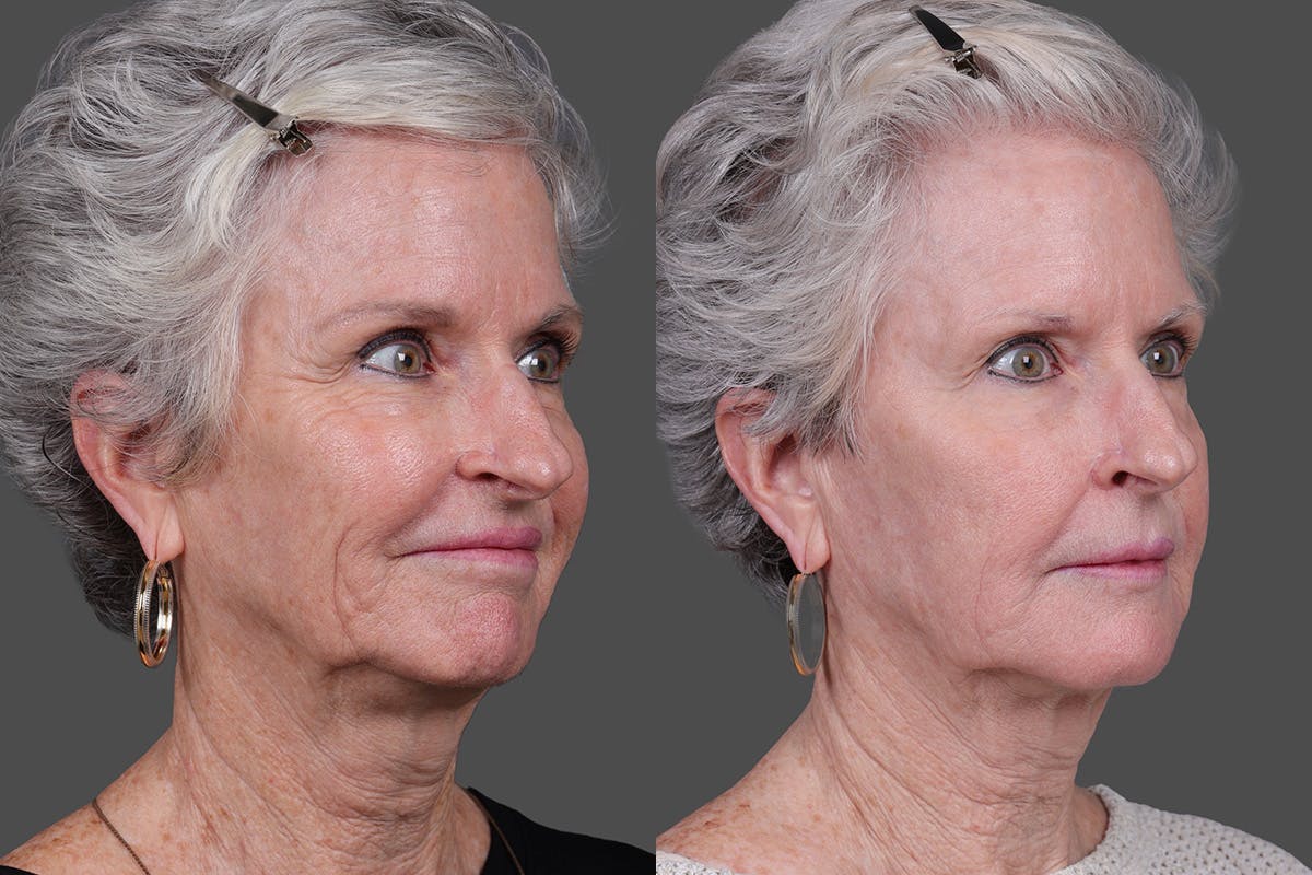 Lasers Before & After Gallery - Patient 100063 - Image 2