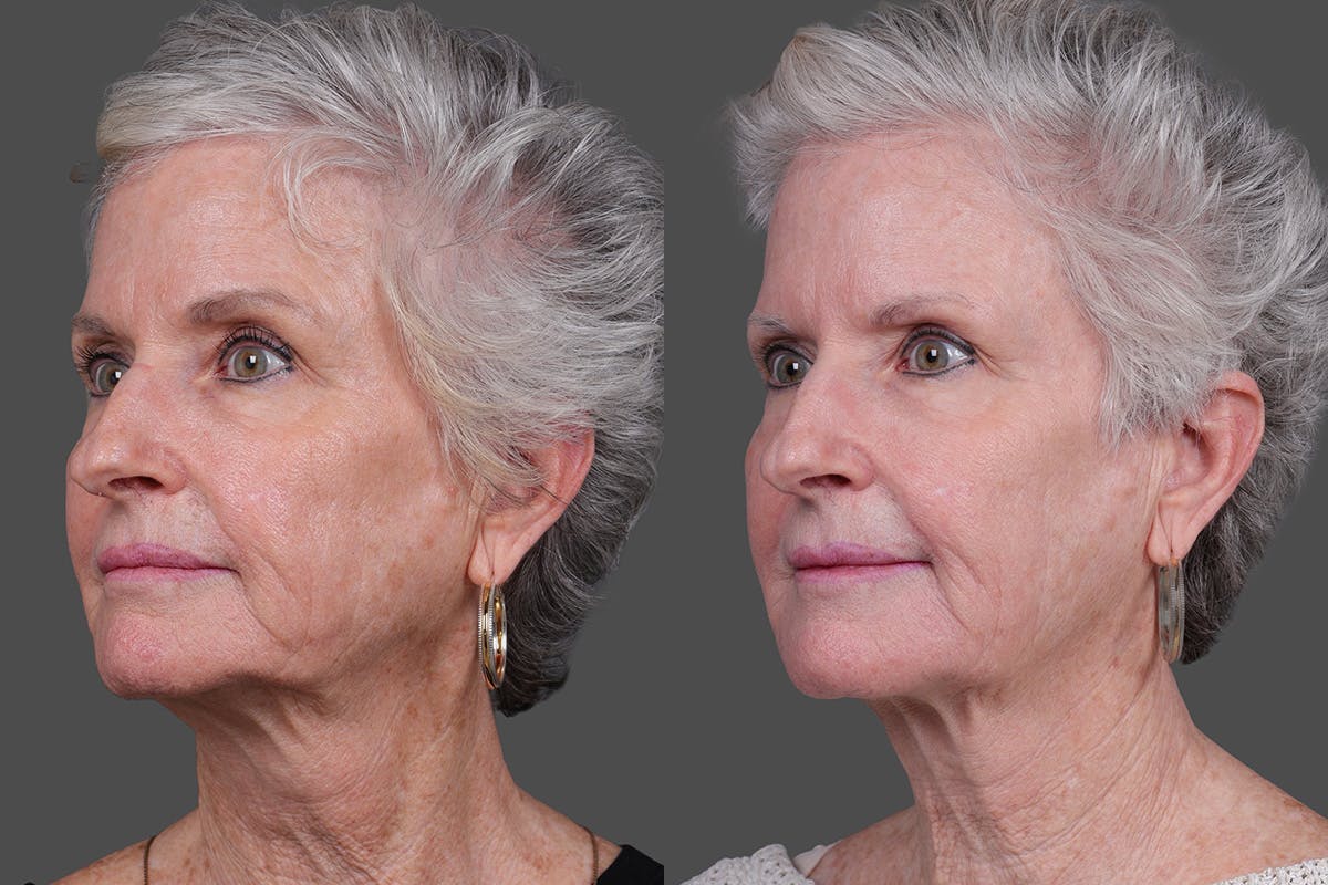 Lasers Before & After Gallery - Patient 100063 - Image 4