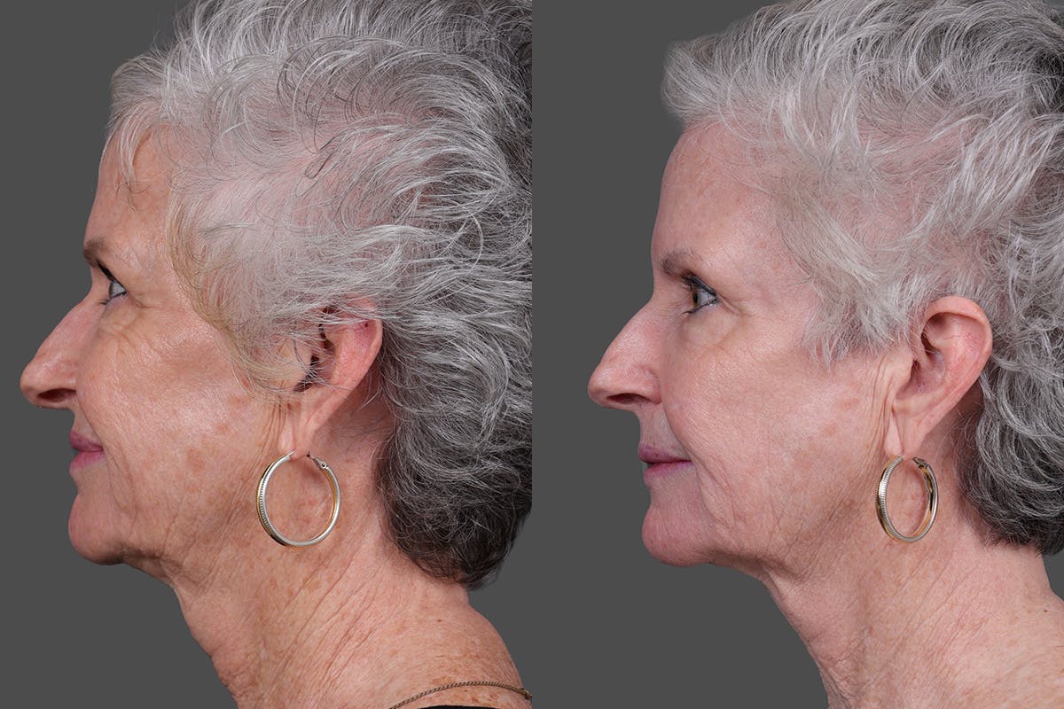 Lasers Before & After Gallery - Patient 100063 - Image 5
