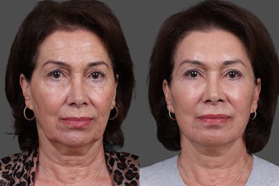 DAXXIFY® Before & After Gallery - Patient 383083 - Image 1