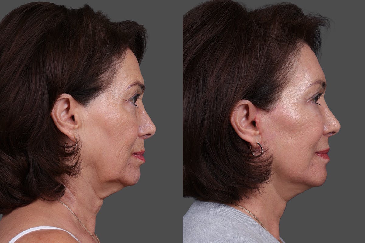DAXXIFY® Before & After Gallery - Patient 383083 - Image 3