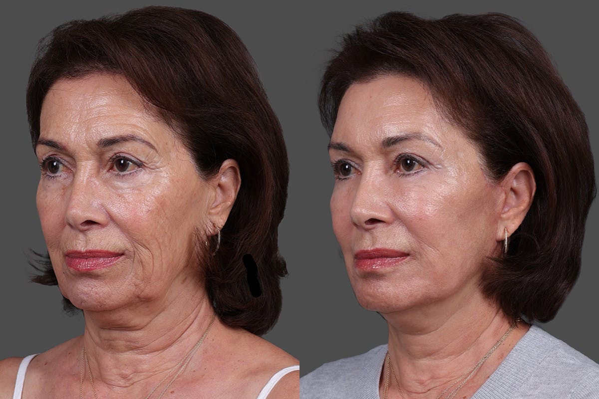 DAXXIFY® Before & After Gallery - Patient 383083 - Image 4