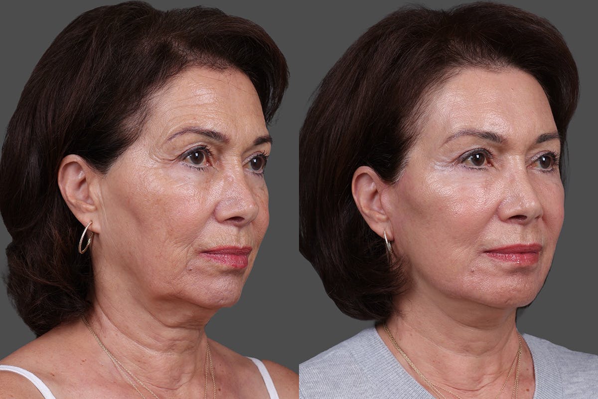 DAXXIFY® Before & After Gallery - Patient 383083 - Image 2