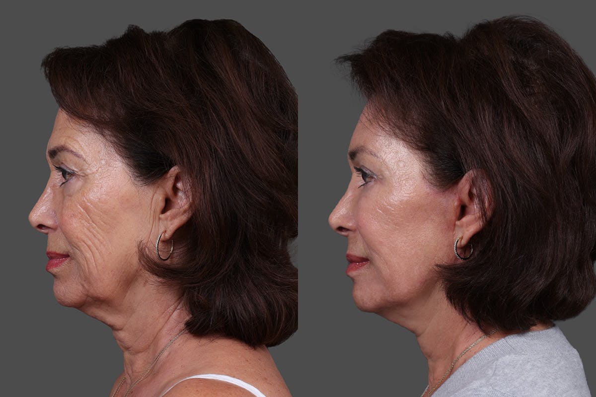 DAXXIFY® Before & After Gallery - Patient 383083 - Image 5