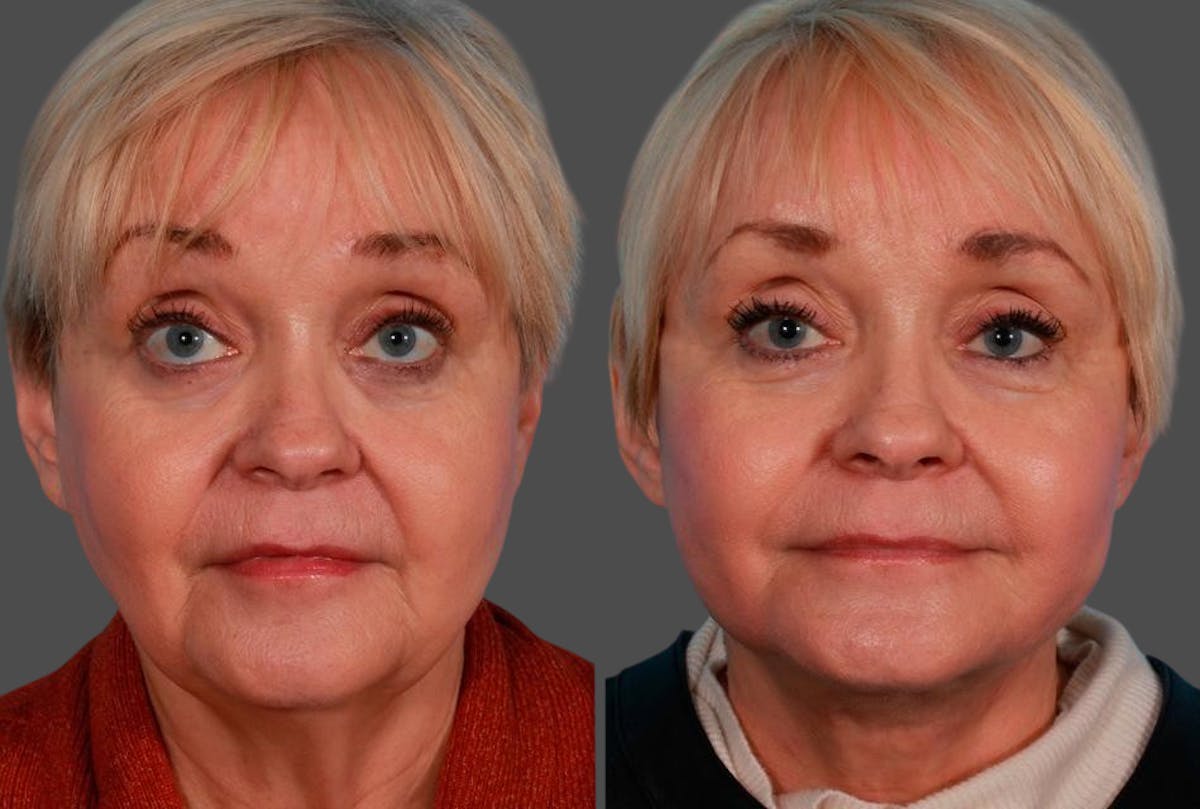 Earlobe Reduction Before & After Gallery - Patient 798779 - Image 1