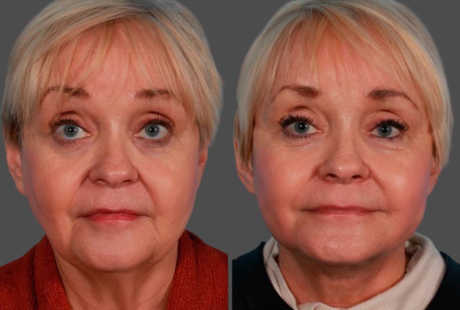 Earlobe Reduction Before & After Gallery - Patient 798779 - Image 1