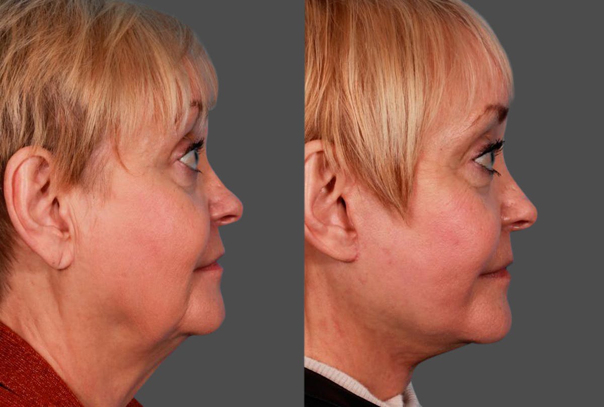 Earlobe Reduction Before & After Gallery - Patient 798779 - Image 2