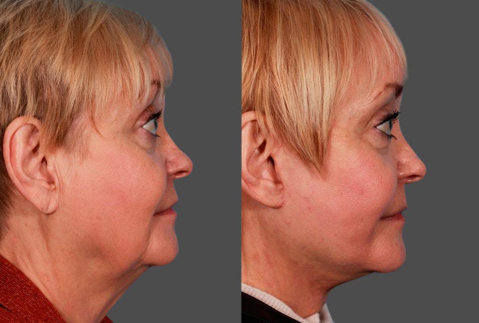 Earlobe Reduction Before & After Gallery - Patient 798779 - Image 2