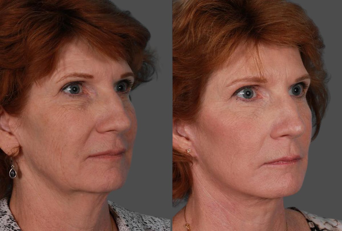 Earlobe Reduction Before & After Gallery - Patient 393154 - Image 2