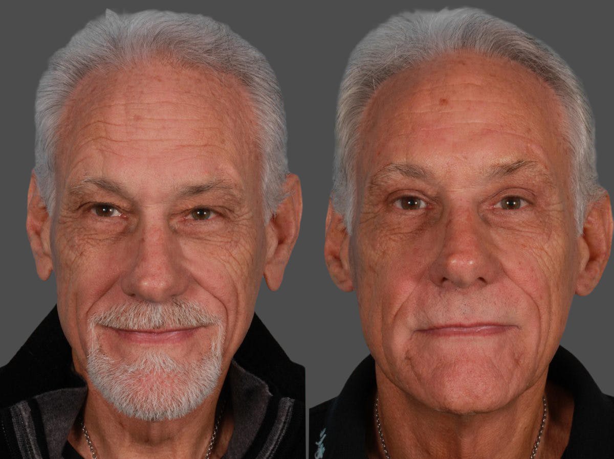 Earlobe Reduction Before & After Gallery - Patient 269246 - Image 1