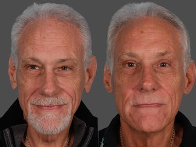 Earlobe Reduction Before & After Gallery - Patient 269246 - Image 1