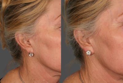 Earlobe Reduction Before & After Gallery - Patient 104005 - Image 1