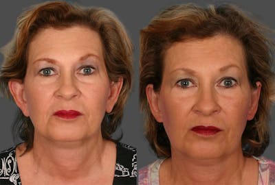 Earlobe Reduction Before & After Gallery - Patient 164228 - Image 1