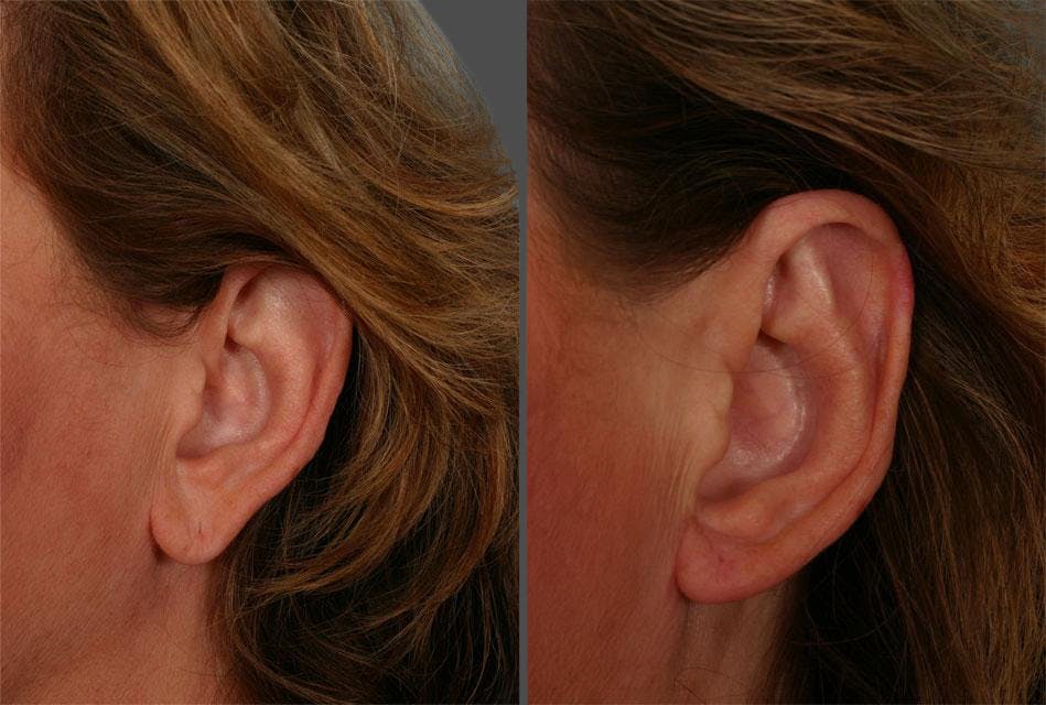 Earlobe Reduction Before & After Gallery - Patient 164228 - Image 2
