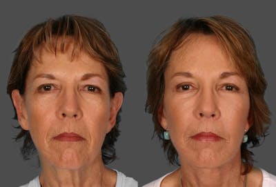 Eyelid Surgery (Blepharoplasty) Before & After Gallery - Patient 936400 - Image 1