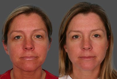 Eyelid Surgery (Blepharoplasty) Before & After Gallery - Patient 758762 - Image 1