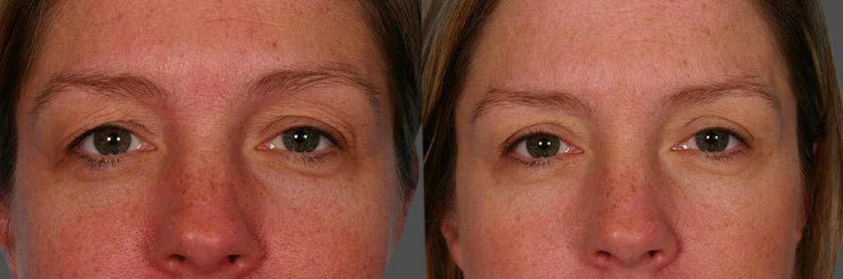 Eyelid Surgery (Blepharoplasty) Before & After Gallery - Patient 758762 - Image 2